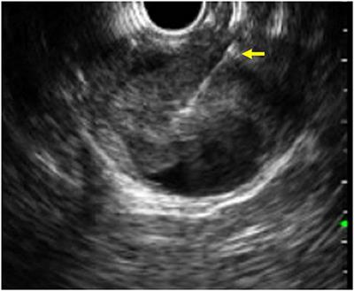 EUS in Pediatrics: A Multicenter Experience and Review